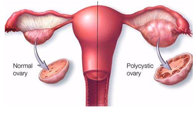Síndrome de ovario poliquístico 1