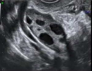 ovario poliquístico 1