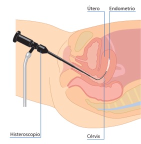 histeroscopia