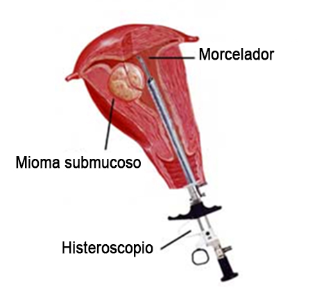 Miomectomía histeroscópica